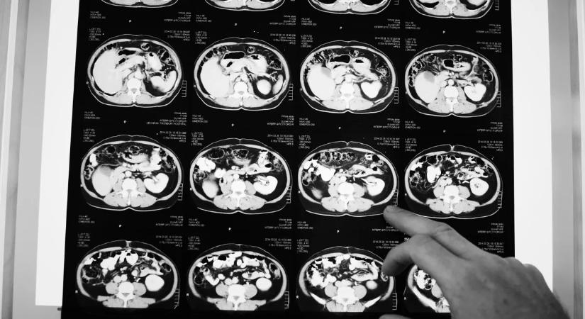 "Ránéztem az orvos arcára, fülsiketítő volt a csend - így tudtam meg, hogy beteg vagyok"