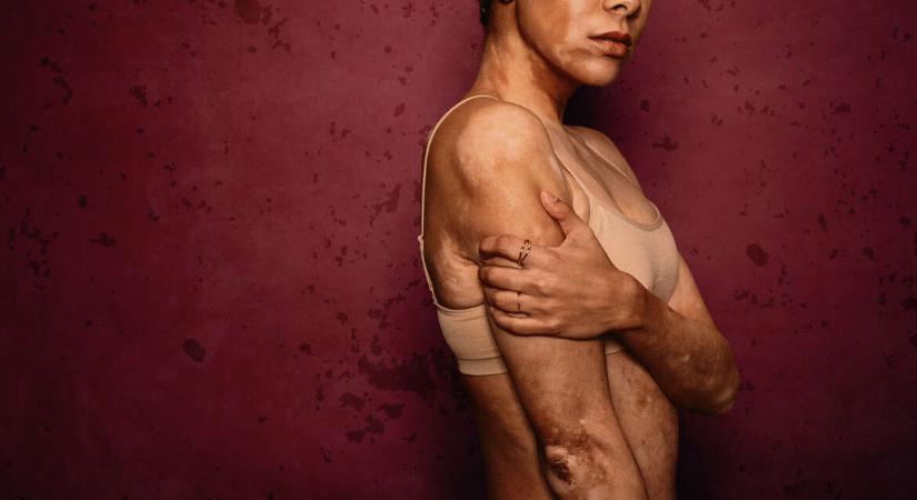 A fájdalmam rajzol rám kitörölhetetlen mintát? – Bőr és lélek kapcsolata az orvos szemével