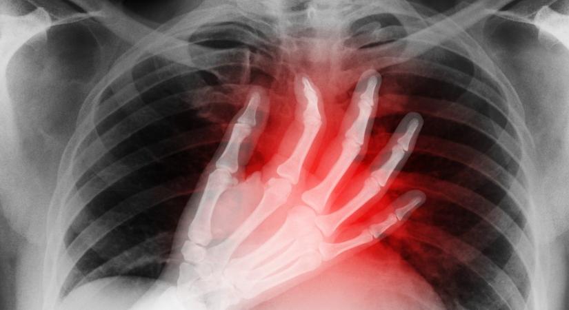 Két napig tüdő nélkül élt egy férfi