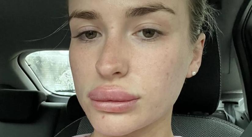 „Az orvosok nem hallgattak rám – majd hirtelen feldagadt az ajkam, és kiütések lepték el a testem”