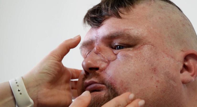 Arcplasztikát kapnak sebesült ukrán katonák
