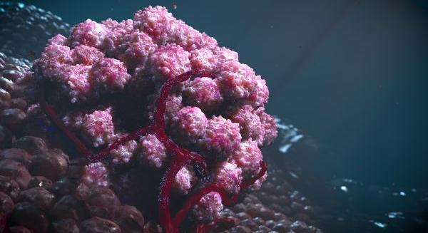 Szono-mechanogenetikai módszer szolid tumorok kezelésében