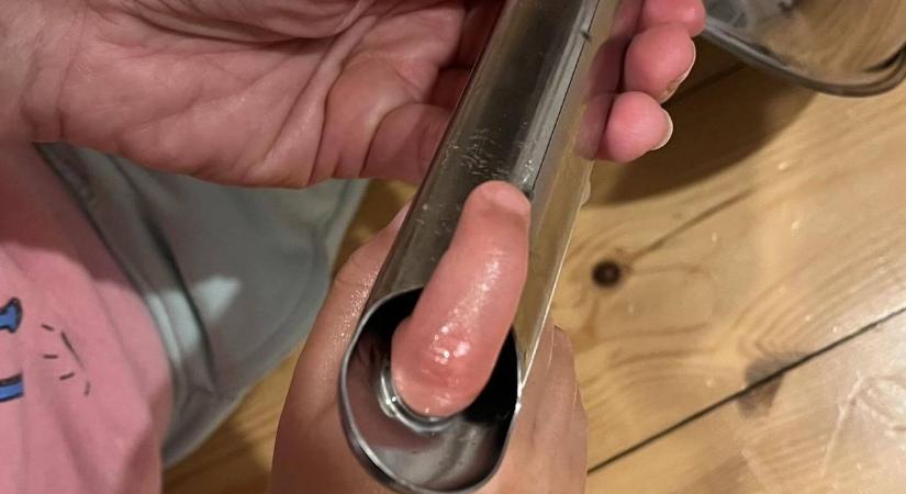 A traumatológián kötött ki az a kislány, aki bedugta az ujját egy serpenyő lyukába