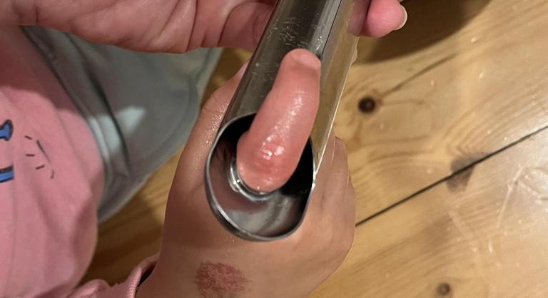 Bedugta ujját a serpenyő nyelén lévő lyukba egy gyermek, a traumatológián végezte