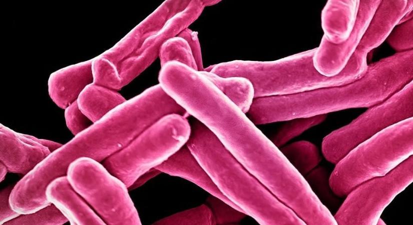 TBC-s megbetegedést igazoltak Hódmezővásárhelyen