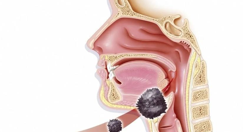 Egy ártalmatlannak hitt tünet, ami torokrákhoz vezethet – ezrek veszik félvállról