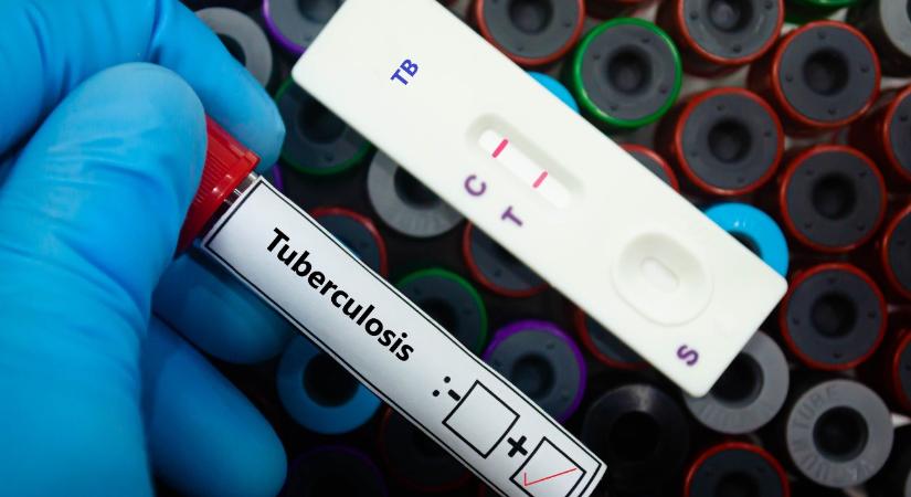 Hódmezővásárhelyi tanárnál igazolták a tbc-t, akár 250 emberrel is kapcsolatba kerülhetett