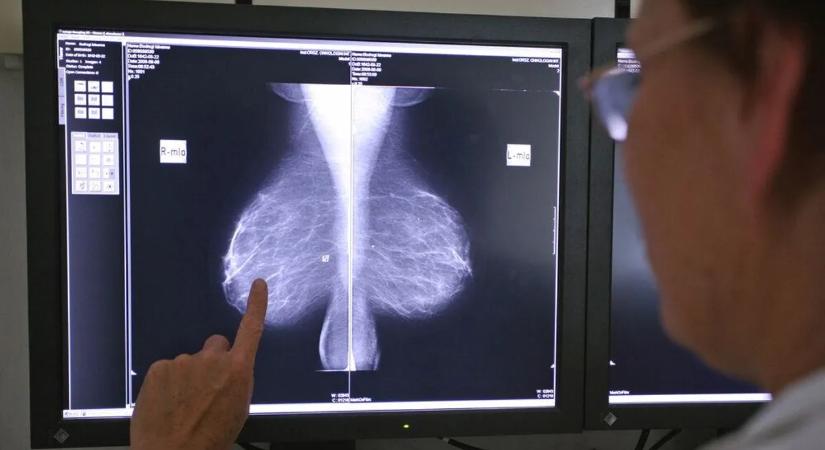 Kinek és milyen rákszűrésen ajánlott részt vennie? Íme a lista!