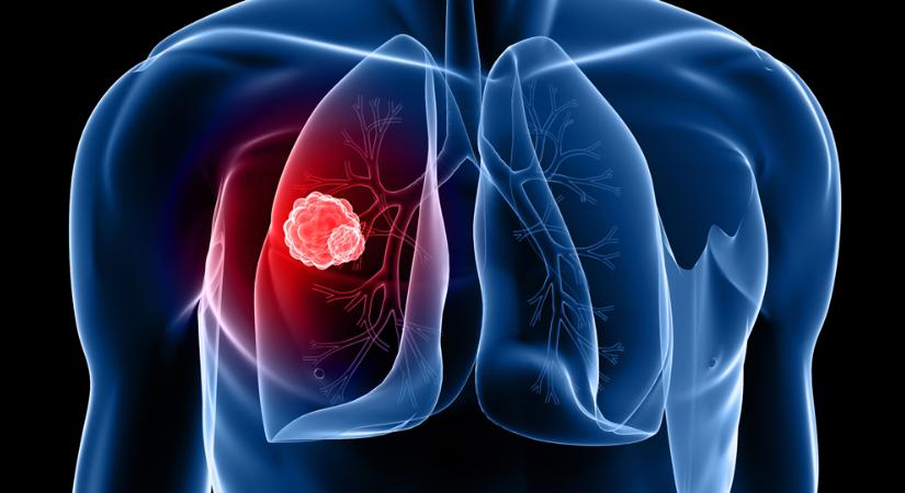 Horvátországban 187 ezer rákos él, túlélés 59 százalék