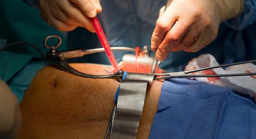 Megdőlni látszik egy régi elmélet a vesekövek keletkezéséről