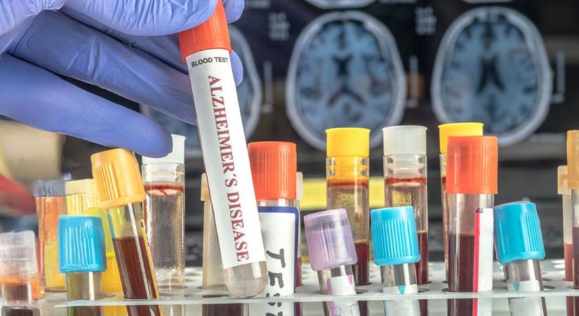 Forradalmi vérteszt készül az Alzheimer-kór korai kimutatására