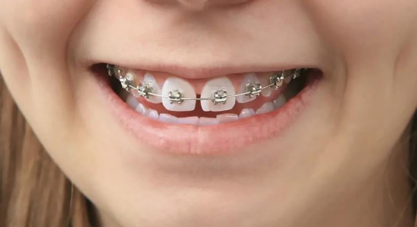 Itt a meglepő magyarázat, miért van szüksége sok embernek fogszabályozóra