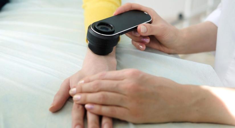 Új bőrvizsgálattal mutathatók ki a szívbetegség korai jelei