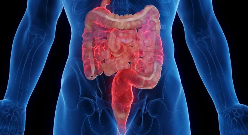 Rejtett veszély leselkedik a bélbetegekre – a csontvelőből indul a baj