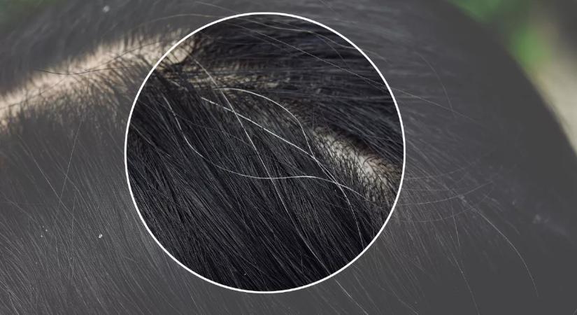 Kevesen tudják: ezért veszélyes kitépni az ősz hajszálakat