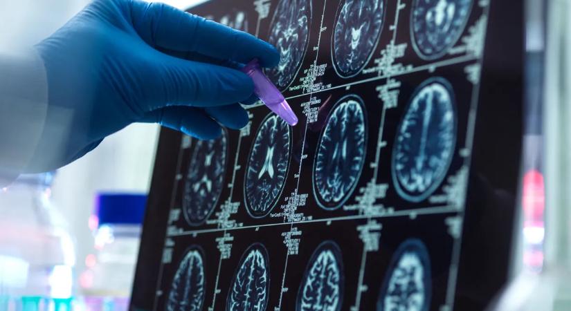 Megvan a rettegett betegség ellenszere? Ígéretes anyagot találtak a népszerű növényben