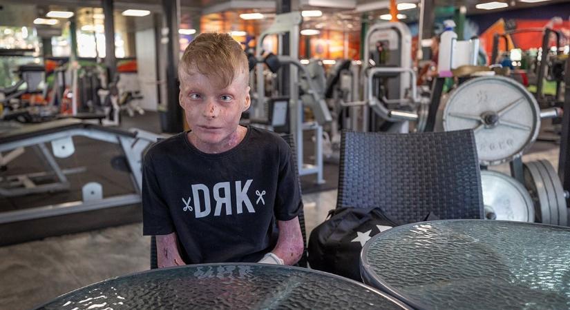 „Szóhoz sem tudtam jutni” – ismeretlen jótevő segített a pillangóbőrrel született Flóriánon