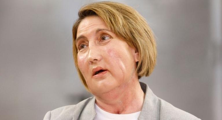 Öngyilkos donor arcát kapta meg az a nő, akit húsevő baktérium támadott meg