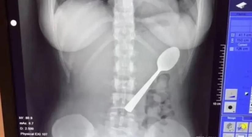 Magyar vizslája ugrott az ölébe, 17 centis kanalat kellett kiszedni a nő gyomrából