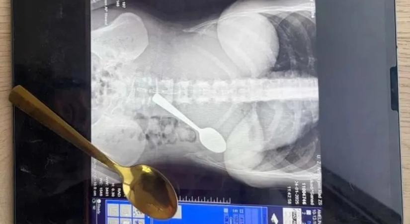 Hihetetlen baleset: lenyelt egy kanalat a nő, hogy ne fulladjon meg