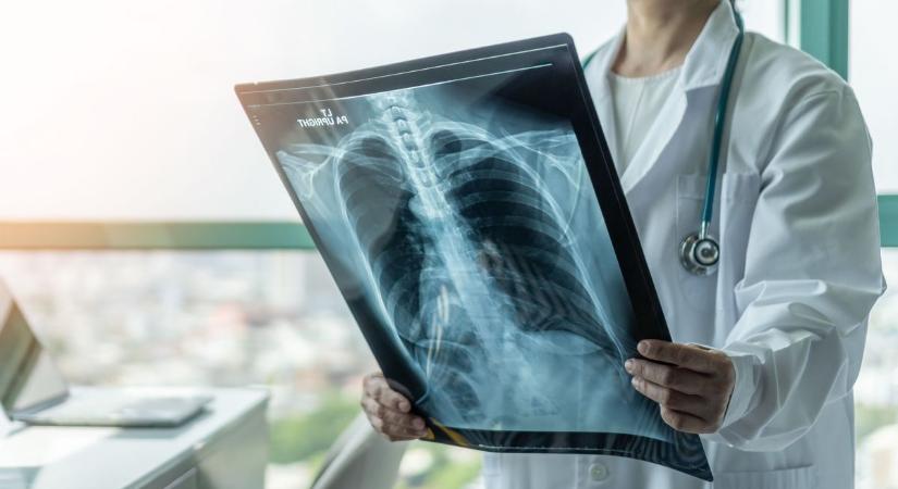 A korai felismerést célozza az országos tüdőegészség-program, dohányosok jelentkezését várják