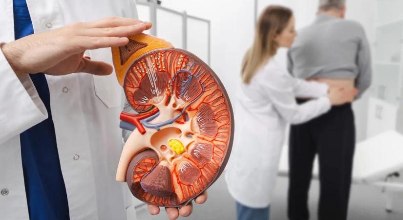 Évtizedes orvosi tévhit dőlt meg: kiderült, mi rejtőzik valójában a vesekőben