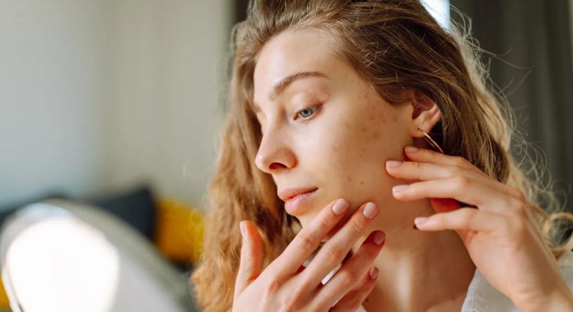 Ezektől az ételektől elmúlnak a pattanásaid