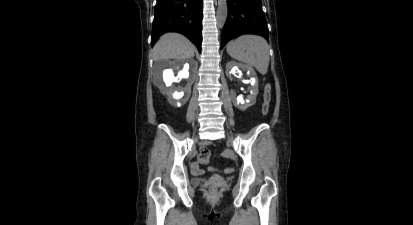 Egy új módszer mikroméretű robotokkal semmisíti meg a vesekövet