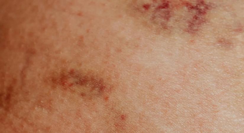 Új, szex közben terjedő fertőzés ütötte fel a fejét – különösen veszélyes egyes emberekre