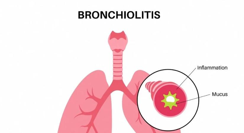 Popcorn tüdő lehet a következménye ennek a konyhai szokásnak