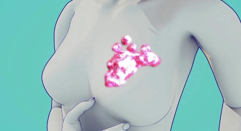 Mellrák kockázat csökkentése – nem csak a genetika számít