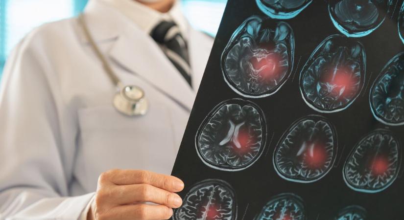Ennél a vércsoportnál magas a stroke veszélye – Már 60 éves kor előtt kialakulhat