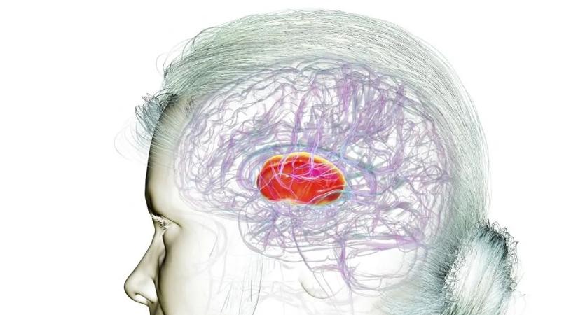 Súlyos probléma a stroke, ezzel teheti a legtöbbet ellene