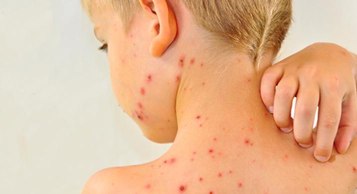 Súlyos átoltottsági válság Romániában: a gyerekek fele nem kapja meg időben a kanyaró elleni vakcinát