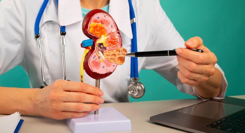 A vesekő kialakulásának eddig ismeretlen oka