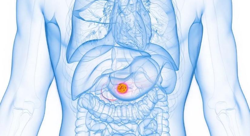 Így védekezhetünk a hasnyálmirigyrák ellen – megtalálták a daganat rejtett üzemanyagát