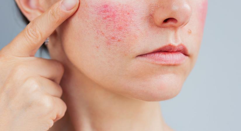 A rosacea kialakulásának okai és kezelése – Így szabadulhatsz meg a kellemetlen tünetektől!
