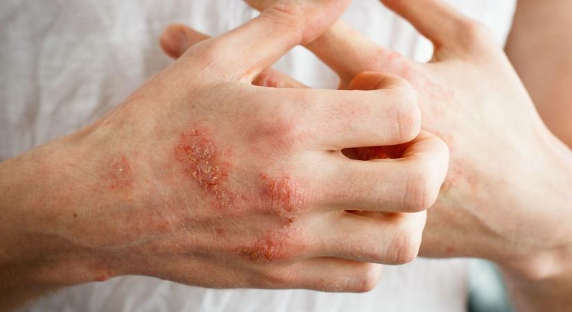 Ez a természetes módszer támogathatja a viszkető bőr gyógyulását