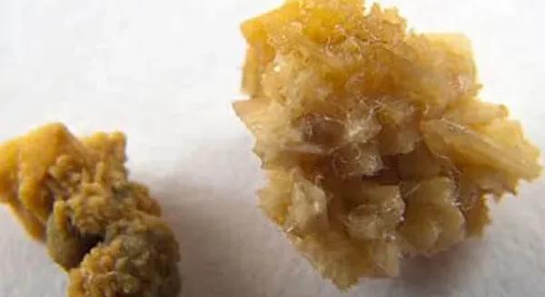 Drágakövek helyett csak a tulaj veseköveit zsákmányolták az olasz betörők