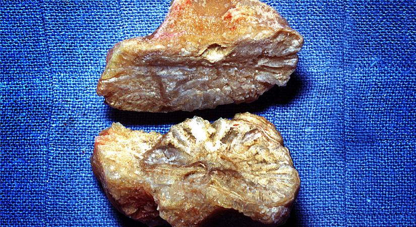 Azt hitték drágaköveket loptak, közben csak a tulaj veseköveit vitték el a betörők