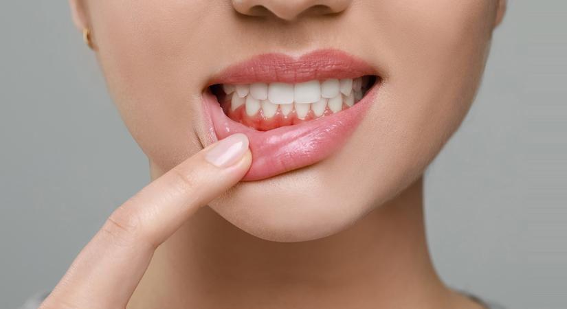 A lepedék a mosoly legnagyobb ellensége!