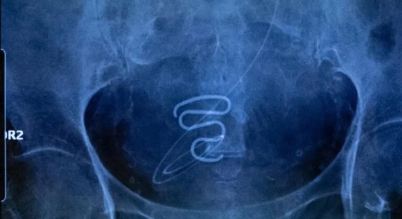 Évtizedekig tartott a horror: 12 éves kislányokba tettek spirált a tudtuk nélkül