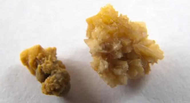 Drágakőnek hitték, de vesekő volt a peches betörők zsákmánya