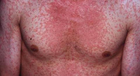 Kanyarójárvány fenyegeti Londont