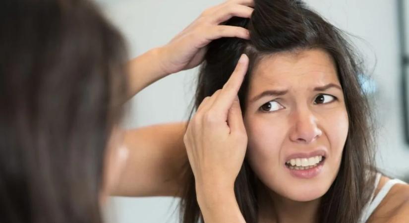 Alig múlt 20 és már őszül? Komoly problémát jelezhet!