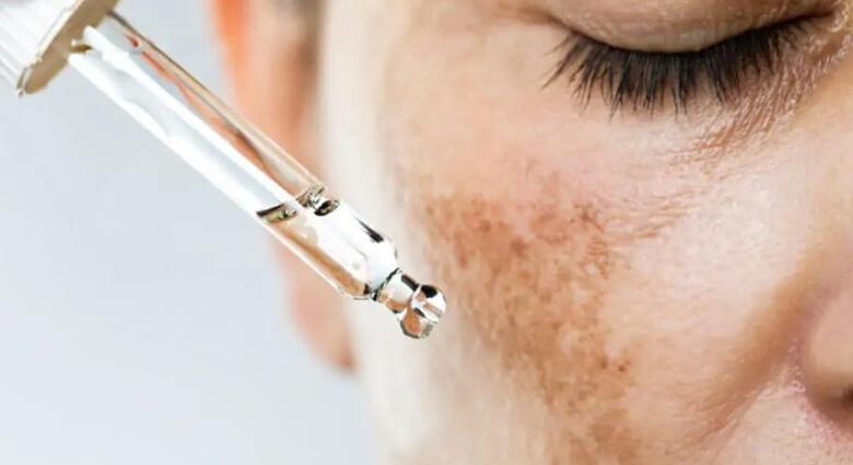 Pigmentfoltok kezelése – mit érdemes tudni?