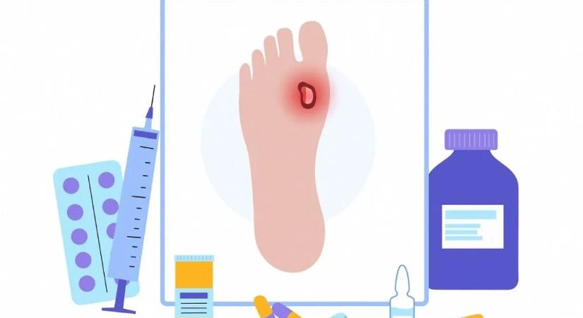 Áttörés a nem gyógyuló sebek kezelésében: az új gél a végtagok megmentésében is segíthet