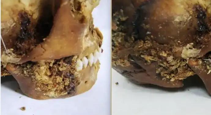 Állkapocsprotézist találtak egy 2500 éves szibériai múmiában