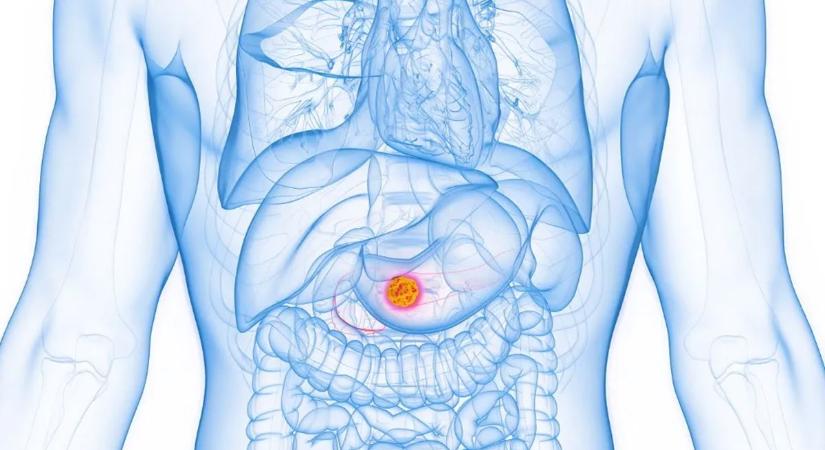 Így védekezhetünk a hasnyálmirigyrák ellen – megtalálták a daganat rejtett üzemanyagát