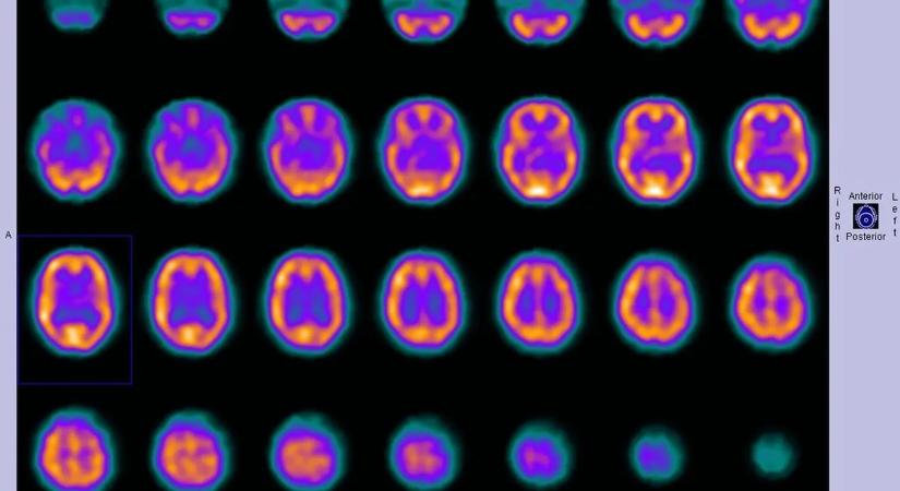 A tudósok felfedezték, mit lát az ember a halál pillanatában